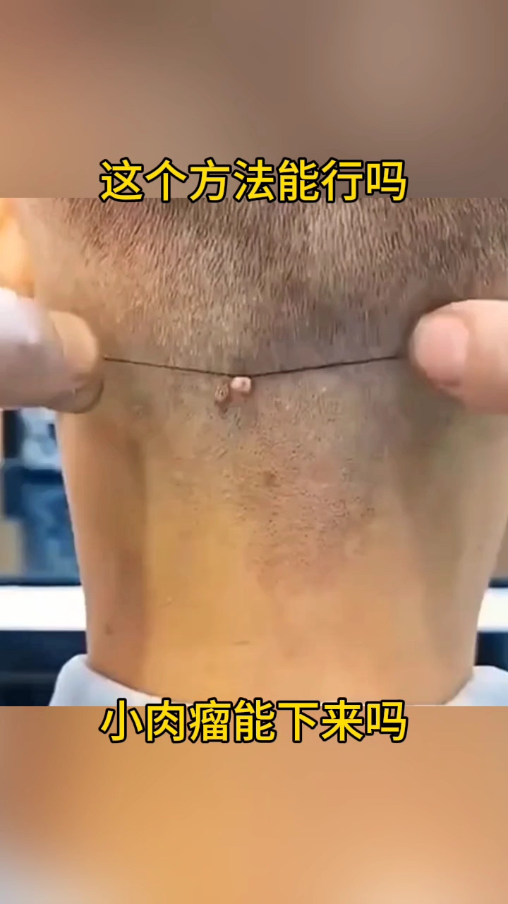 这个方法能行吗?小肉瘤能下来吗