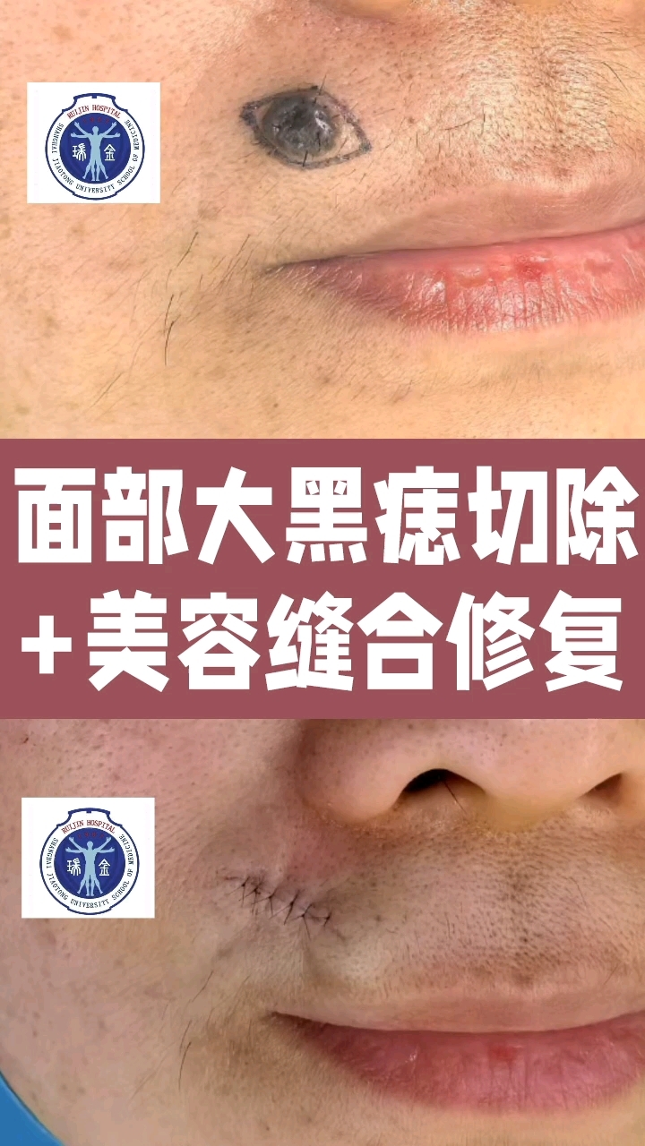 面部大黑痣/肉痣切除,美容修复术