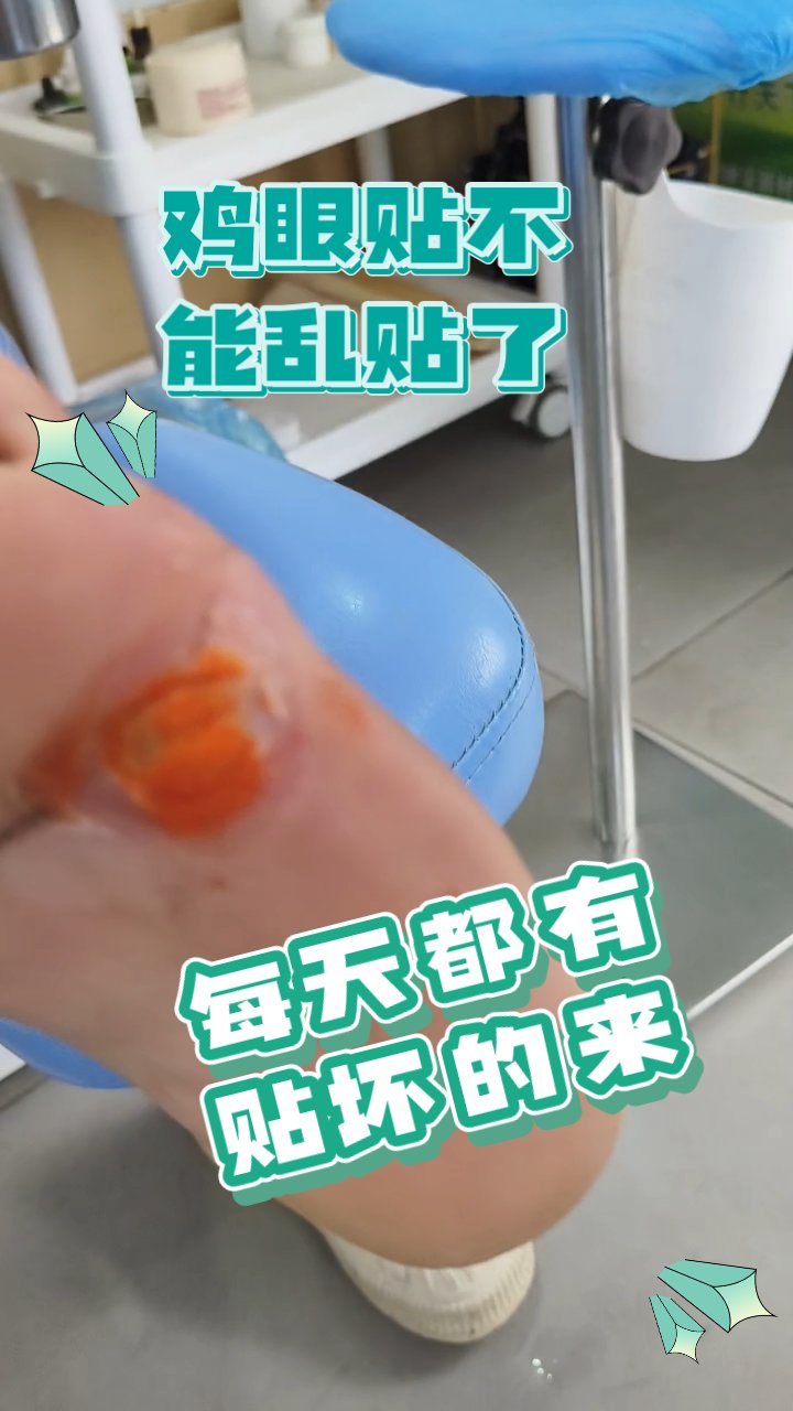 慎贴鸡眼膏!避免肉烂悲剧