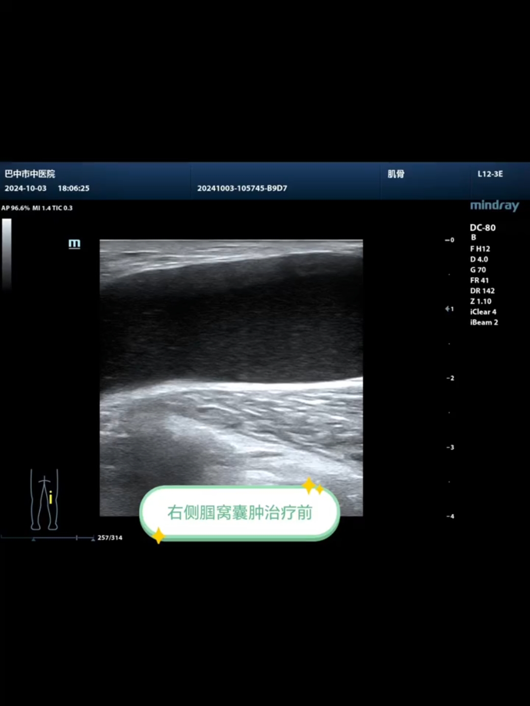 超声引导下腘窝囊肿硬化治疗