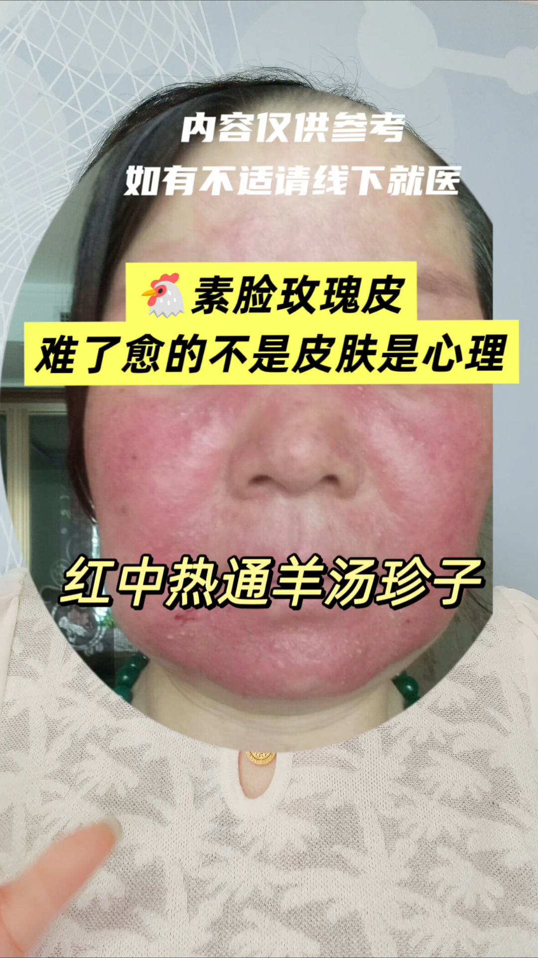 鸡素脸玫瑰皮难修复是心理不是皮肤?