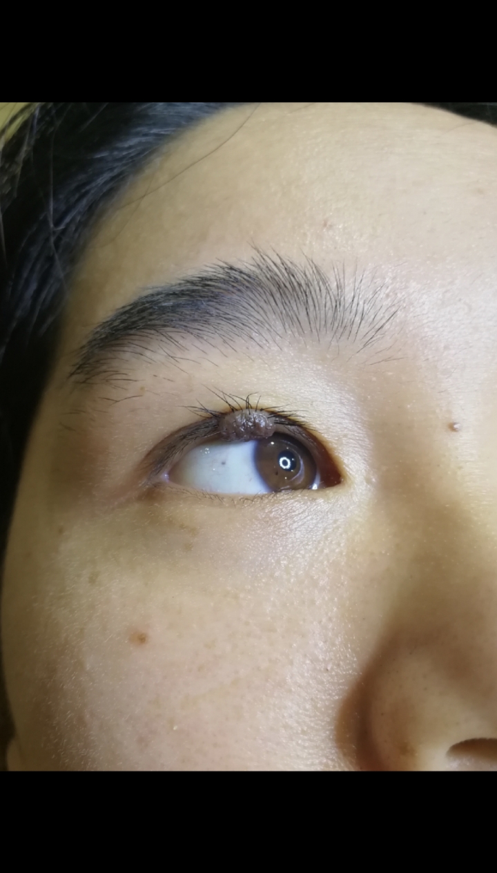 一次性无痛祛除眼睫毛根部的大肉痣,不伤害睫毛。