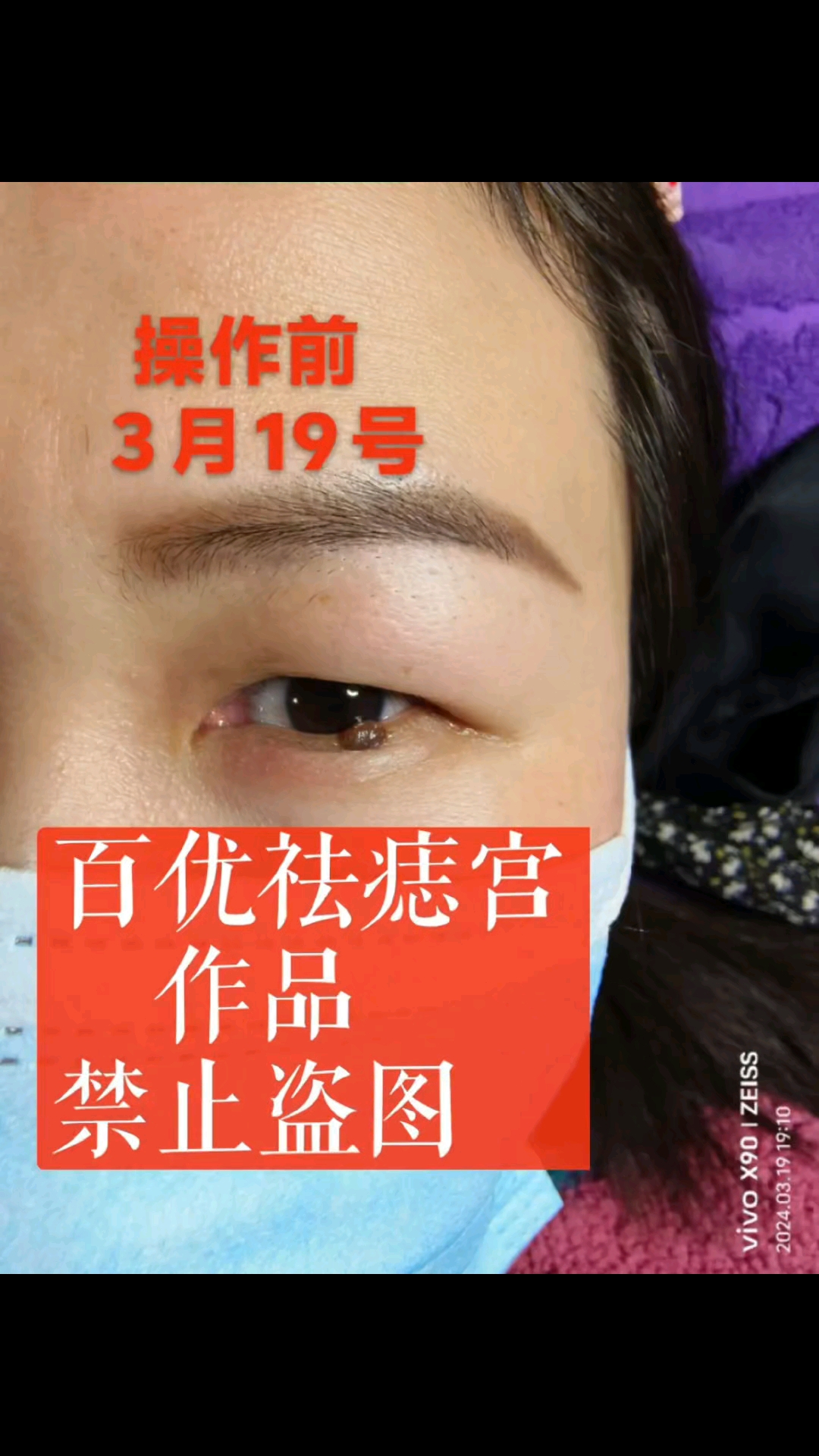 一次性祛除下眼睑部位的大肉痣