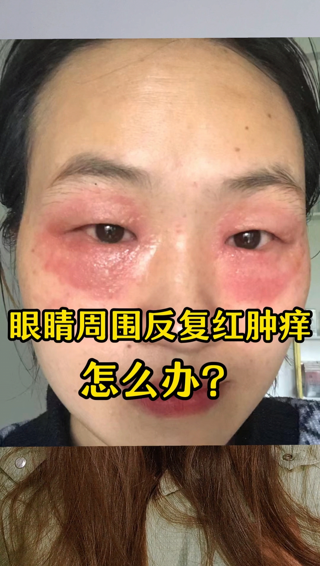眼睛周围反复红肿痒应该怎么办呢,这几点告诉你