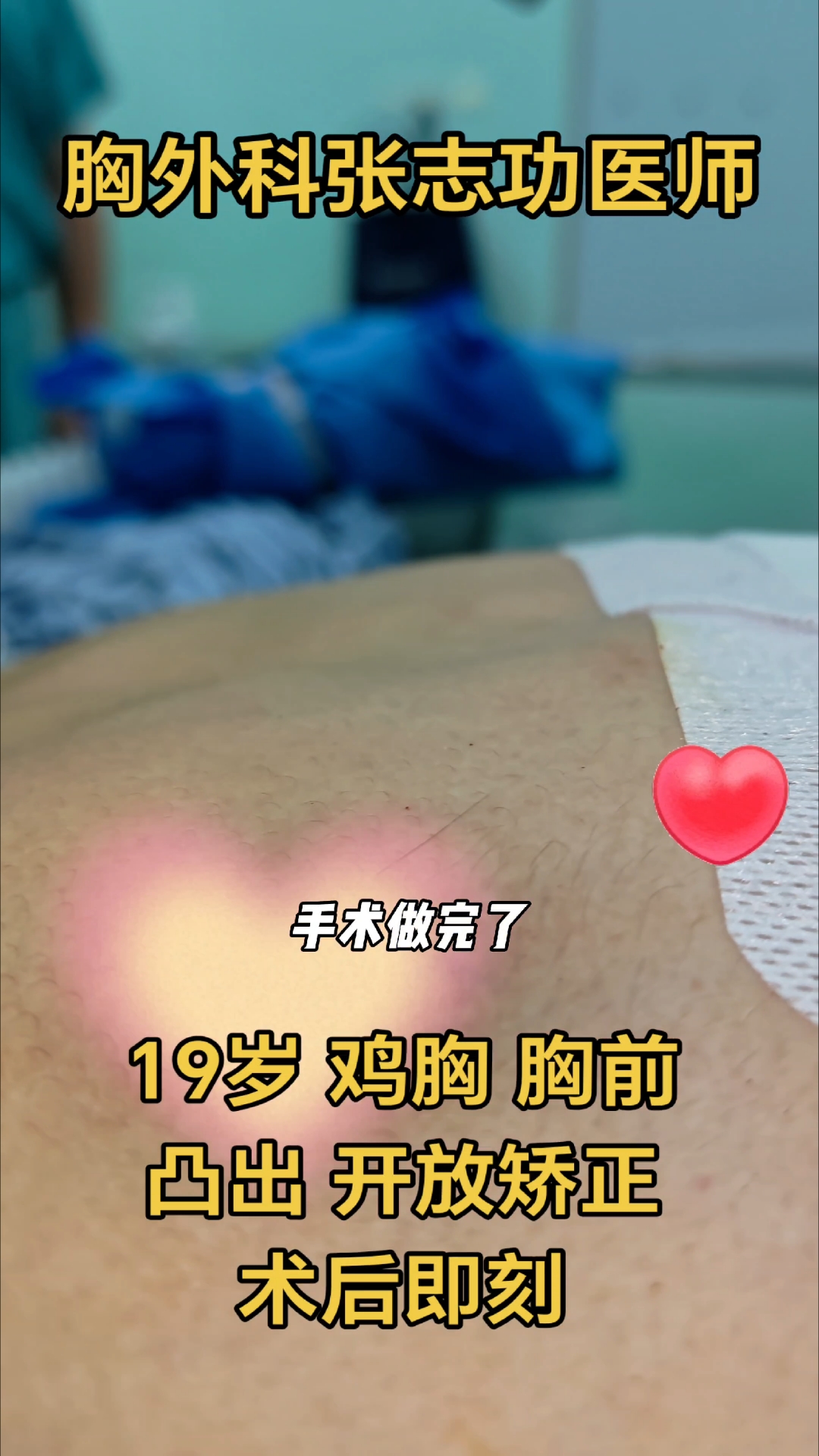 19岁 不对称鸡胸,成年人胸前凸出,开放矫正术,术后即刻外观