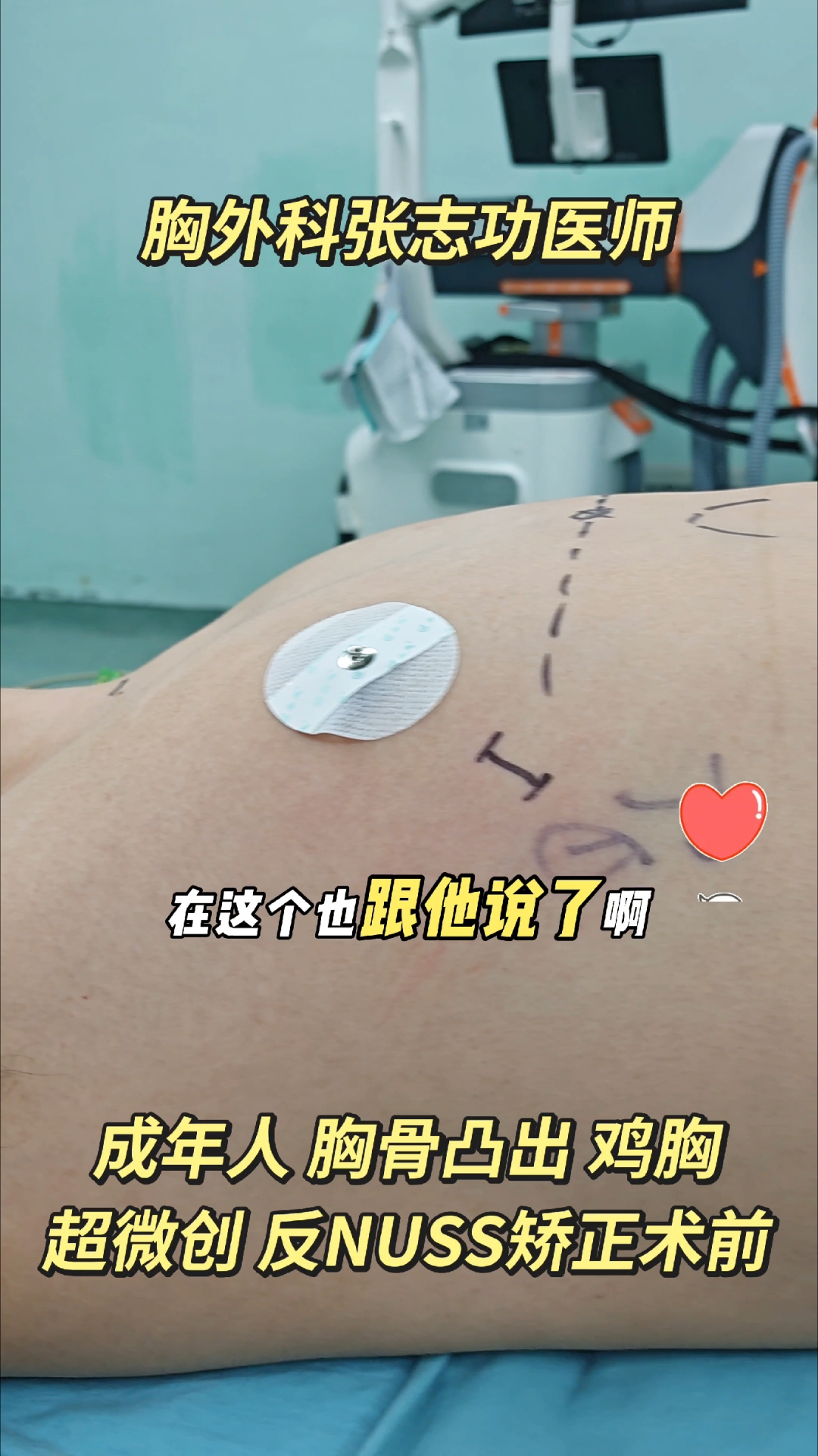 #成年人 #胸部 #突出,#胸骨 #凸出,#鸡胸,#超微创