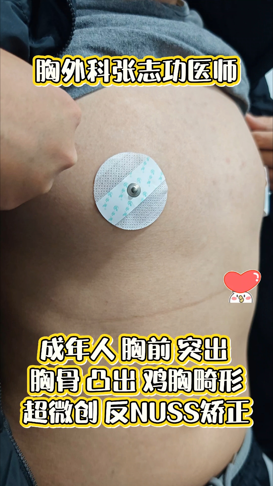 成年人胸部突出 胸骨凸出 鸡胸 超微创,反Nuss矫正术前