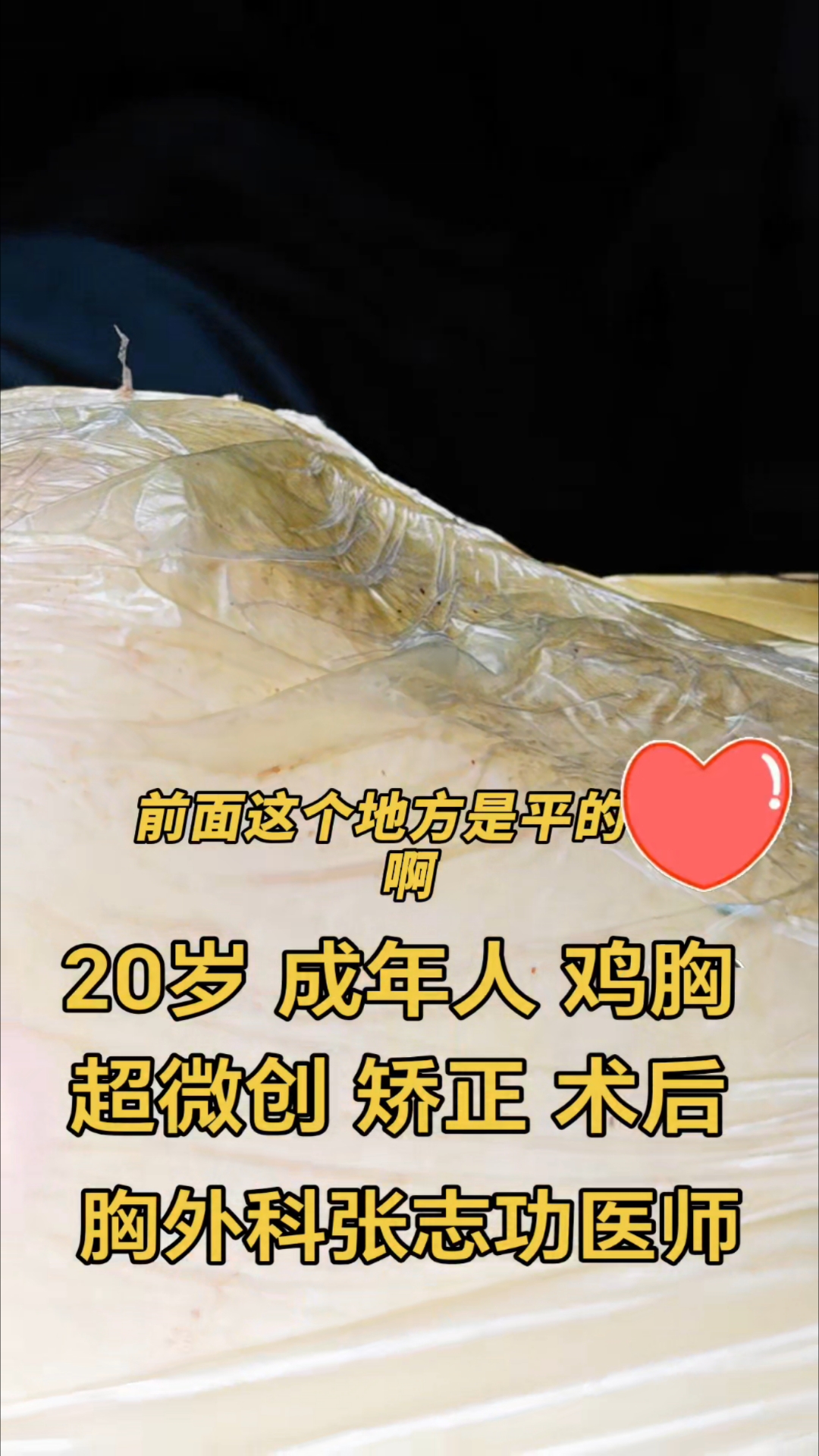 20岁 成年人 鸡胸 超微创 矫正 术后即刻