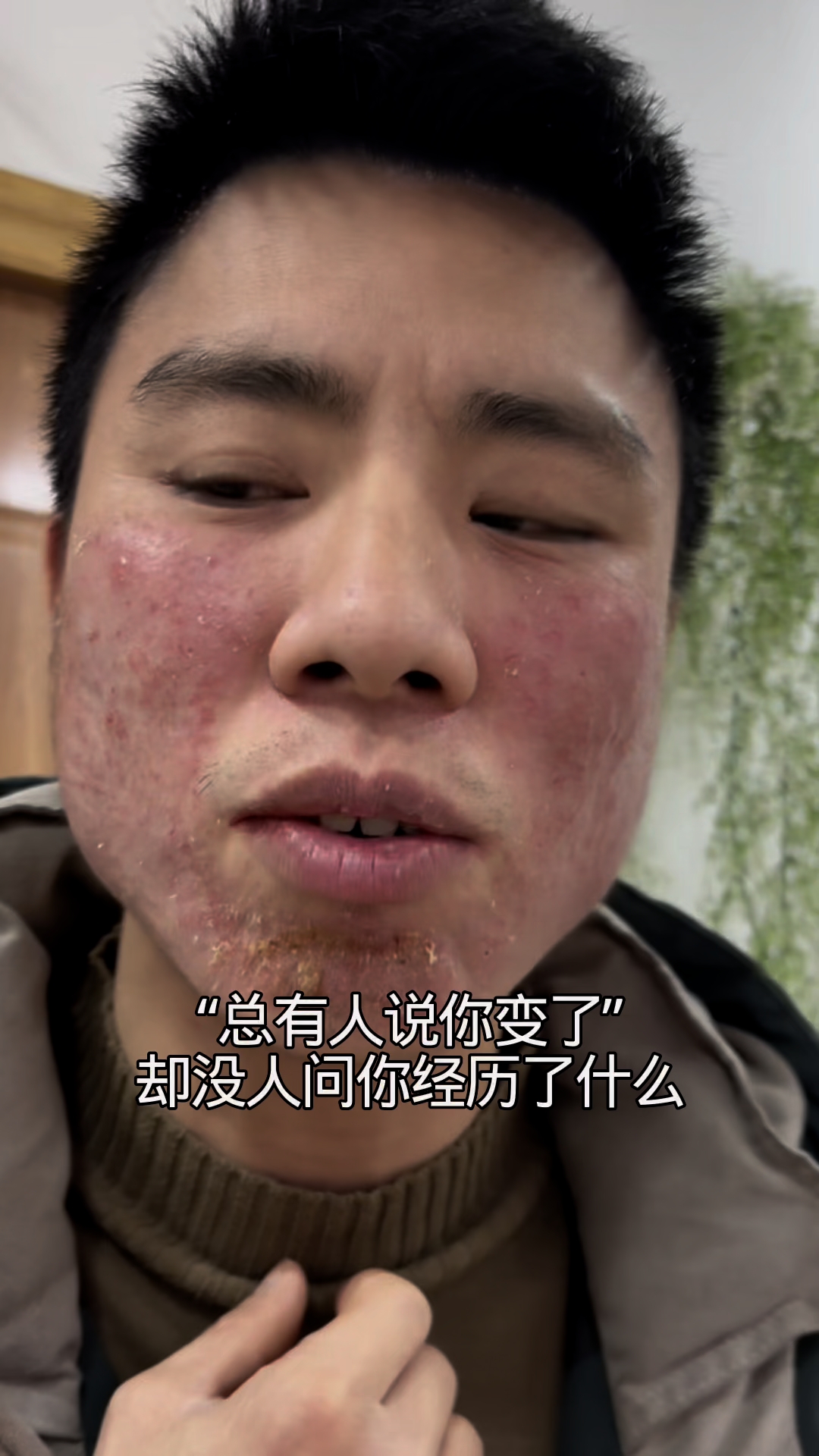 激素脸红肿热痒痛,流黄水结痂,通过深层修复后上岸5反弹