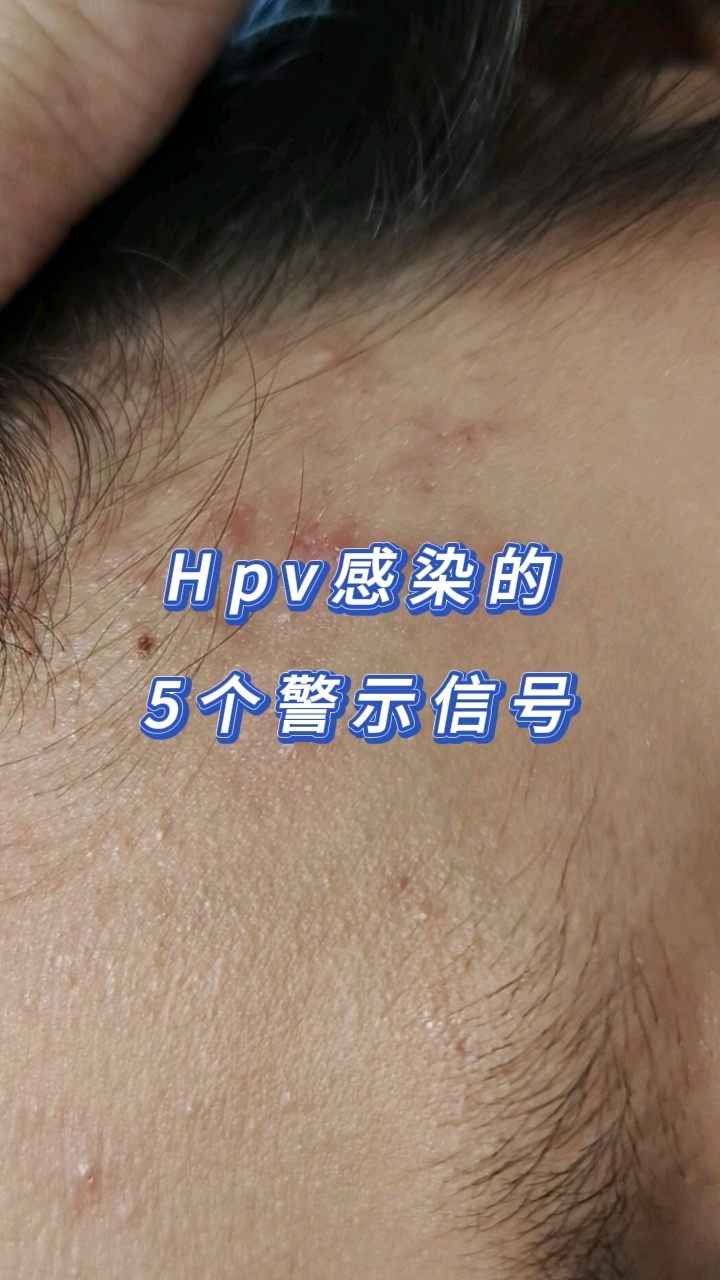 hpv感染的5个信号