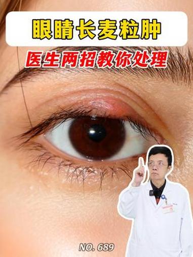 眼睛长麦粒肿，千万不要挤啊！医生教你正确处理 麦粒肿 长针眼 眼睛 健康科普破圈计划 健康