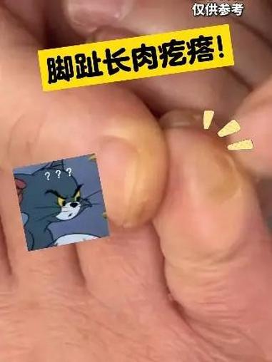 长鸡眼走路痛!医生手把手教你三步处理,温和又简单~
