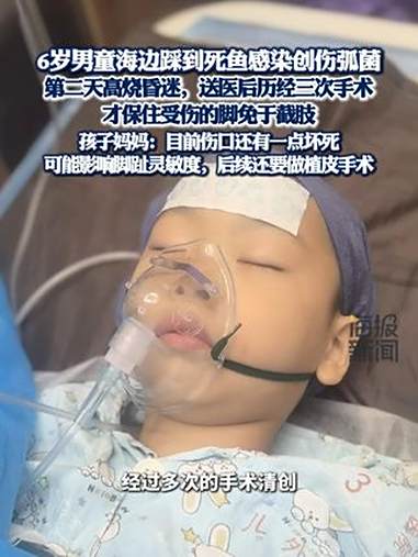 6岁男童海边踩到死鱼感染创伤弧菌高烧昏迷 孩子妈妈：脚保住了，目前伤口还有一点坏死，后续还