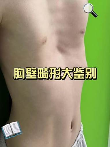 胸壁畸形大鉴别 鸡胸 肋骨外翻 漏斗胸 儿童胸外科李飞 抖出健康知识宝藏