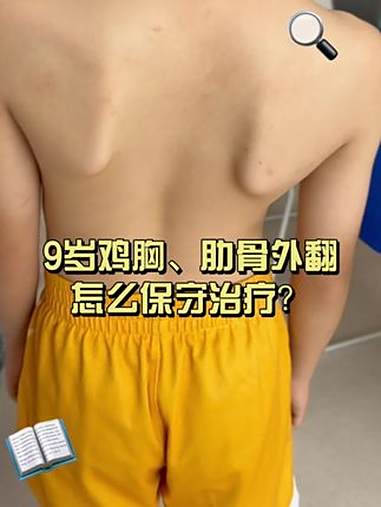 9 岁鸡胸、肋骨外翻怎么保守治疗 鸡胸 肋骨外翻 漏斗胸 儿童胸外科李飞 抖出健康知识宝藏