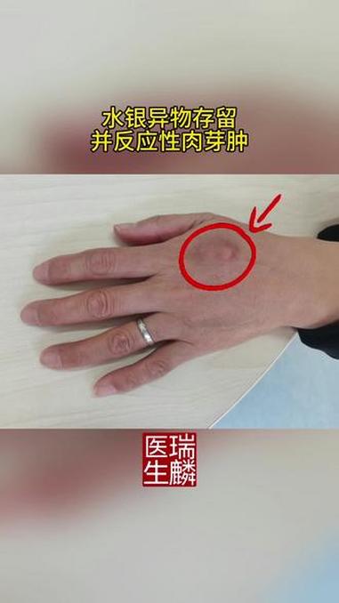 水银异物存留并反应性肉芽肿 水银异物 反应性肉芽肿 肉芽肿 异物 手背肿物