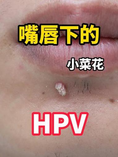 嘴唇下的小菜花 HPV hpv 寻常疣 瘊子 抖出健康知识宝藏 健康科普破圈计划