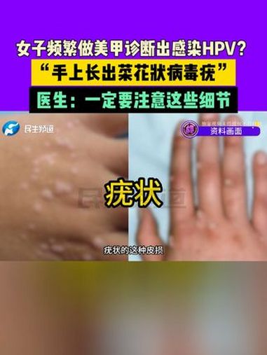 女子频繁做美甲诊断出感染HPV?“手上长出菜花状病毒疣”,医生:一定要注意这些细节 常识中