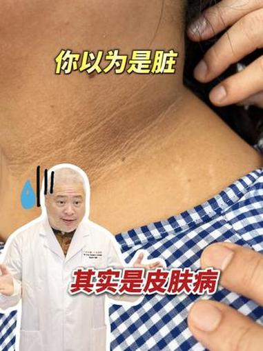 这可不是没洗干净澡,而是皮肤病!#血糖 #鱼鳞病 #抖出健康知识宝藏 #脏 #涨知识