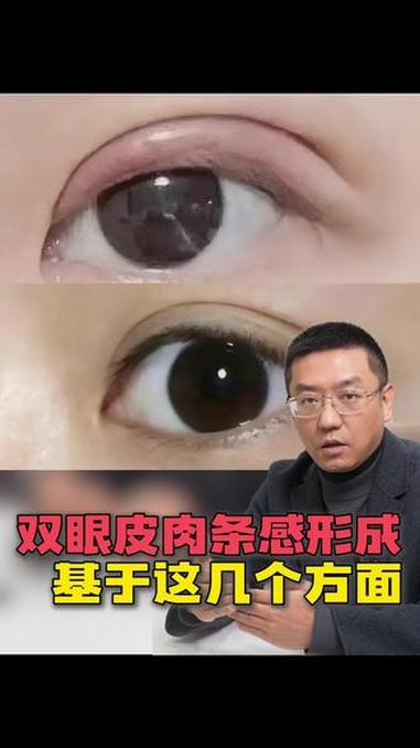 双眼皮肉条感形成基于这几个方面!#上海双眼皮 #双眼皮手术 #郭峰双眼皮 #肉条感 #双眼