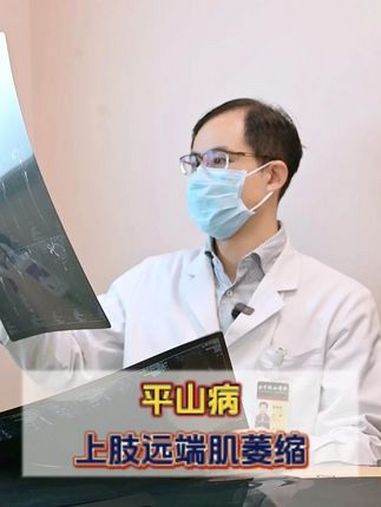 平山病上肢远端肌萎缩 门诊日常 平山病 肌肉萎缩 脊髓受压