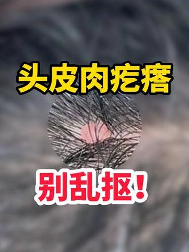 头皮肉疙瘩 别乱抠 #皮赘 #皮脂腺囊肿 #皮赘小肉球 #抖出健康知识宝藏 #新年囤点专业