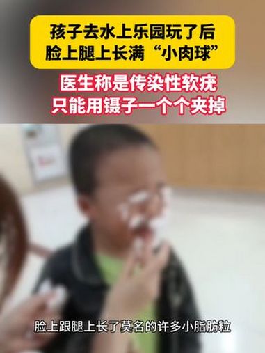 孩子去水上乐园玩了后,脸上腿上长满“小肉球”,只能用镊子一个个夹掉