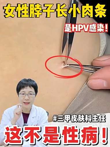 女性脖子上长小肉条,别担心,这不是性病,而是会传染的丝状疣!HPV 丝状疣 女性健康 传染