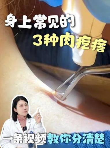 身上常见的3种肉疙瘩,不是病!皮肤科医生教你如何正确区分处理 #脂肪瘤 #皮赘 #皮脂腺囊