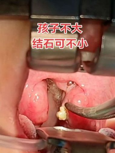 四岁女孩,巨大扁桃体结石一例 四岁女孩,长了一个巨大扁桃体结石!大如黄豆!扁桃体 扁桃体结