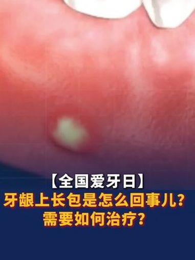 全国爱牙日 牙龈上长包是怎么回事儿?需要如何治疗?