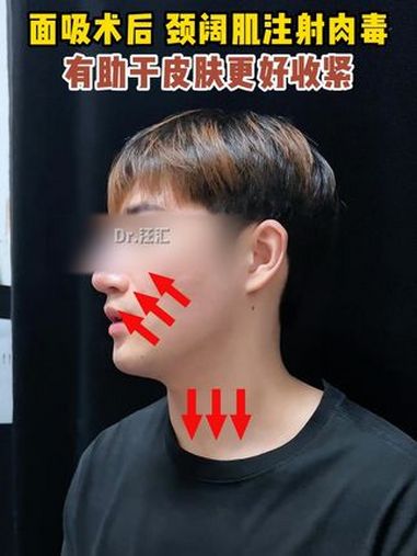 面吸术后 颈阔肌注射肉毒,有助于皮肤更好收紧 男性 面吸 面部吸脂 江华医生团队