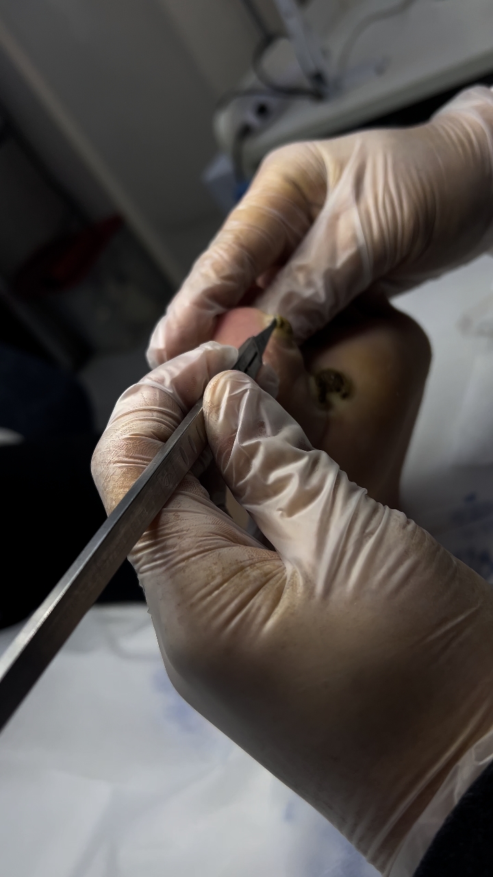 20岁小伙脚趾上长了三个跖疣～2