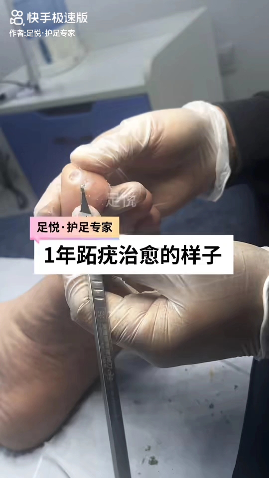 一年跖疣治愈的样子