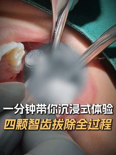 一分钟带你沉浸式体验 四颗智齿拔除全过程 智齿 拔牙 四颗智齿一起拔 王佃灿 北大口腔医院