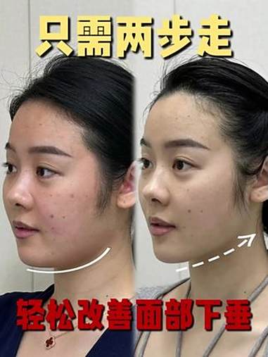 只需两步走,轻松改善面部下垂!苹果肌复位 面部提升 医生科普 西安齐红莉 硬核健康科普行动