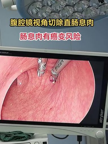 直肠息肉切除
