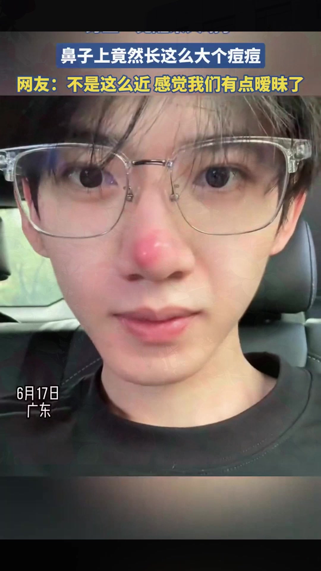男生一觉醒来天塌了,鼻子上竟然长这么大个痘痘