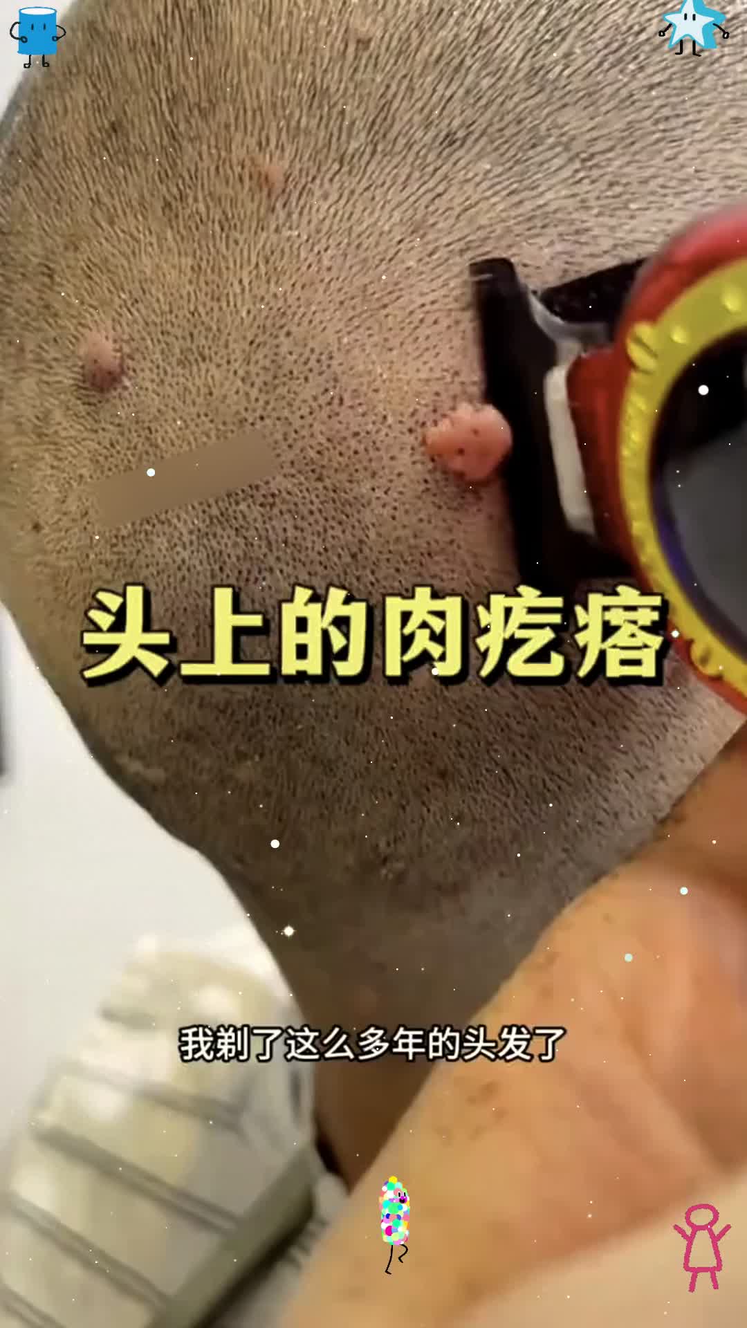 头上的肉疙瘩，理发的时候特别困难