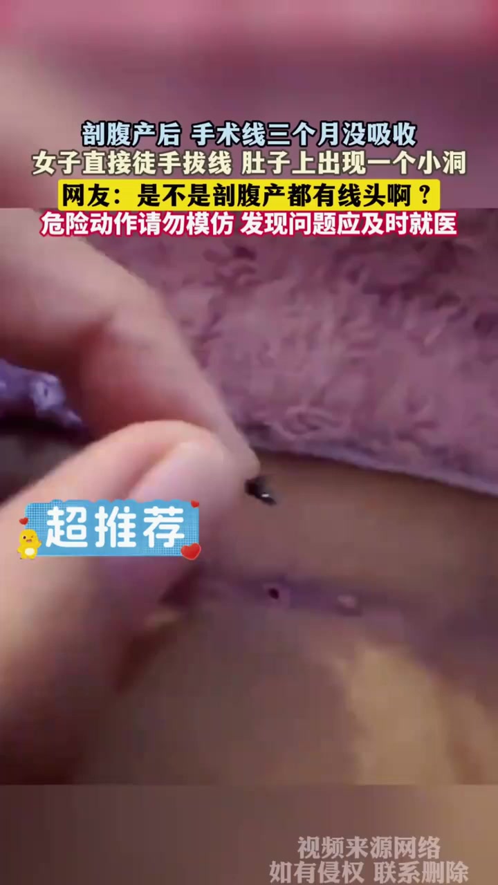 剖腹产后 手术线三个月没吸收,女子直接徒手拔线