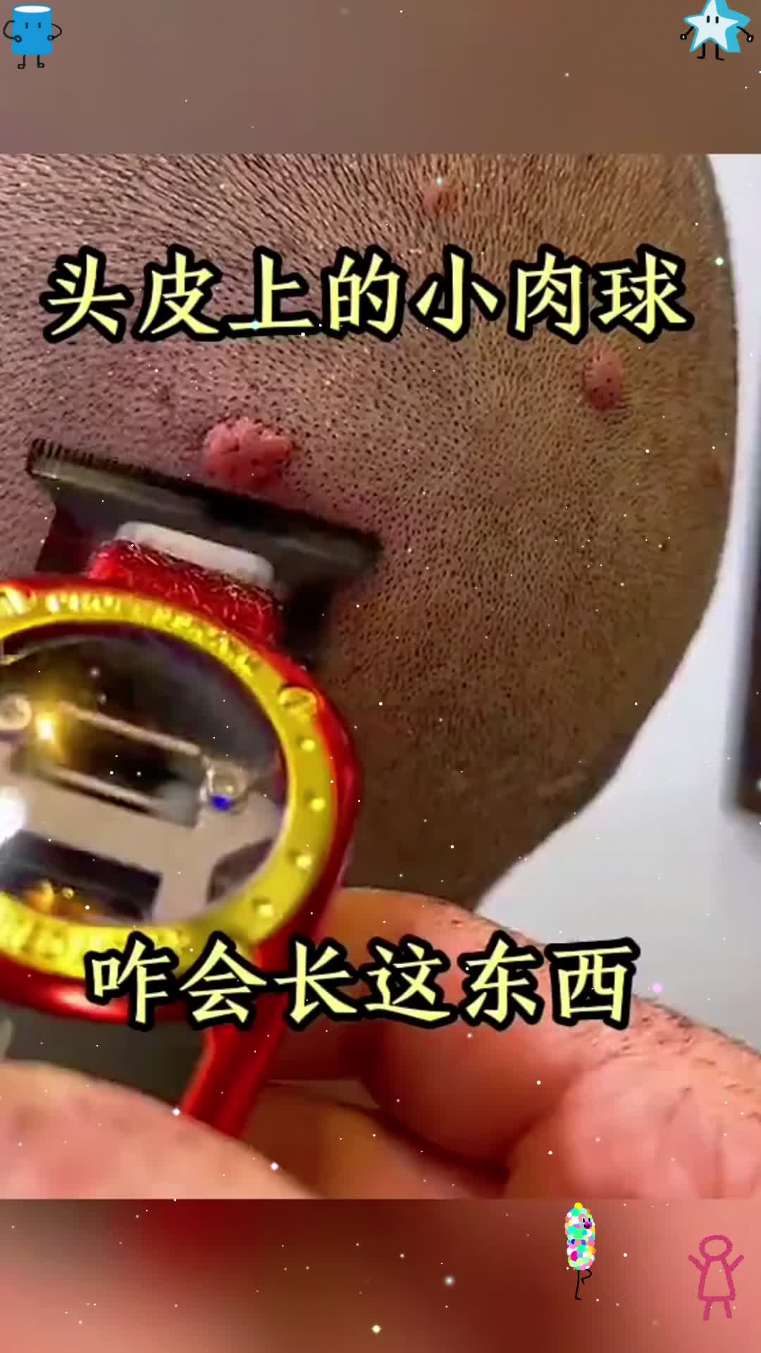 头皮上的小肉球，咋会长这东西！