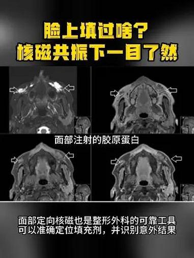 上填过什么东西,核磁共振都能看到!医学科普 面部填充