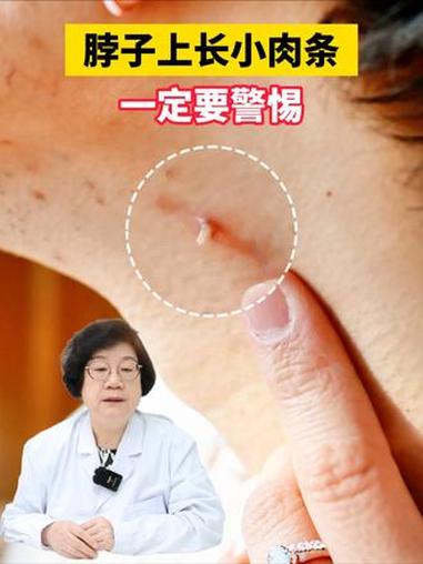 脖子上长小肉条千万别瞎剪，医生教你在家正确处理 #丝状疣 #HPV #抖出健康知识宝藏 #