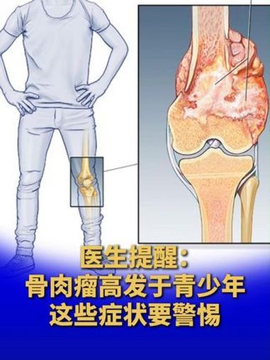 医生提醒:骨肉瘤高发于青少年,这些症状要警惕!骨肉瘤为何被称为青少年杀手 中新健康