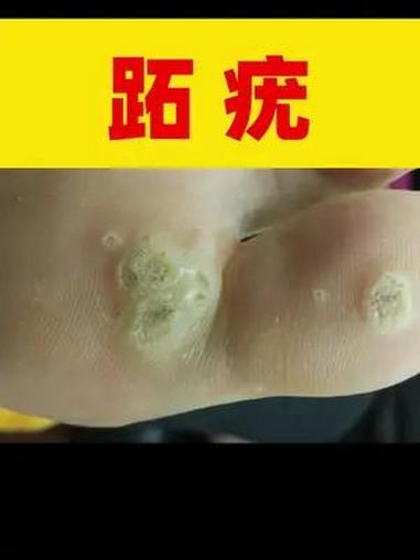 脚上长这种硬疙瘩,你还以为是鸡眼吗