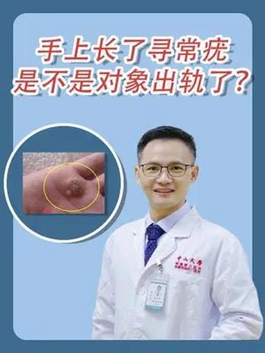 手上长了 寻常疣,是不是对象出轨了?冷知识 医学科普