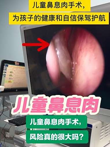 儿童鼻息肉手术，风险真的很大吗？专家为您全面解析，儿童鼻息肉手术，为孩子的健康和自信保驾护
