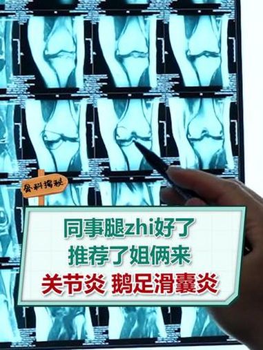 膝关节疼痛 膝骨关节炎 鹅足滑囊炎 prp 医者仁心