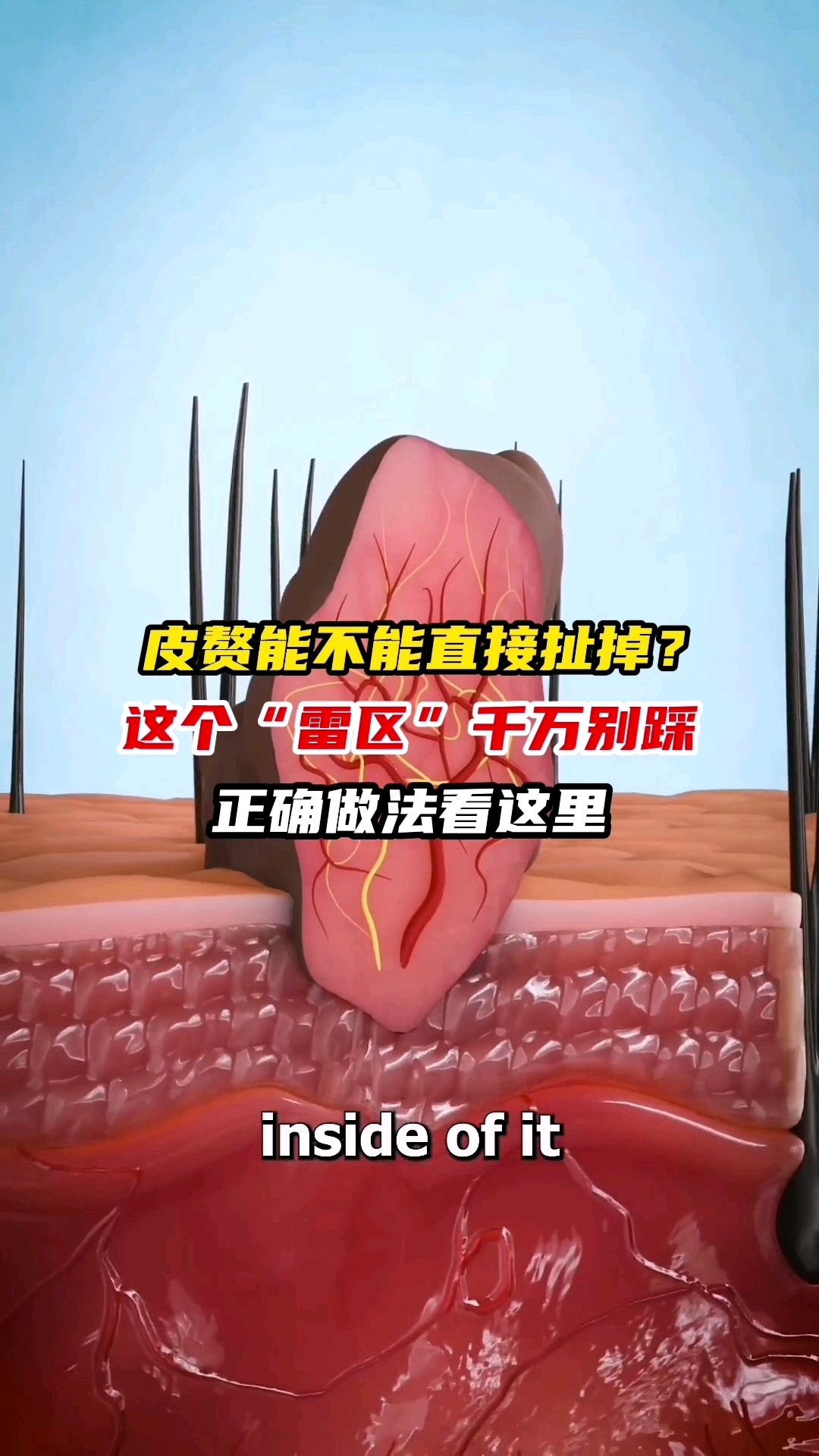 皮赘能不能直接扯掉?这个“雷区”千万别踩,正确做法看这里