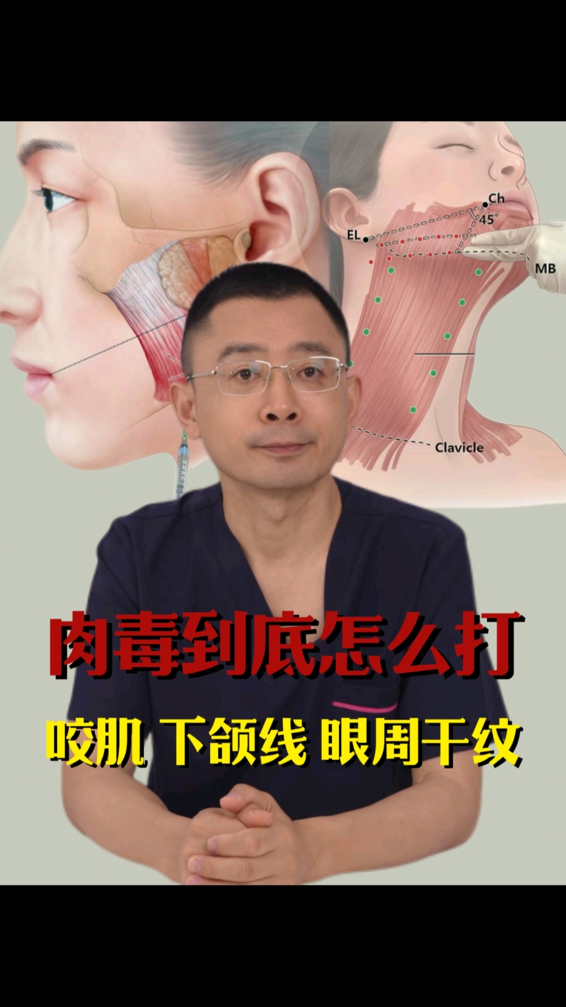 肉毒素到底怎么打？瘦脸 / 紧致下颌 / 淡眼纹一次讲透 #肉毒#整形医生范巨峰#抗衰#
